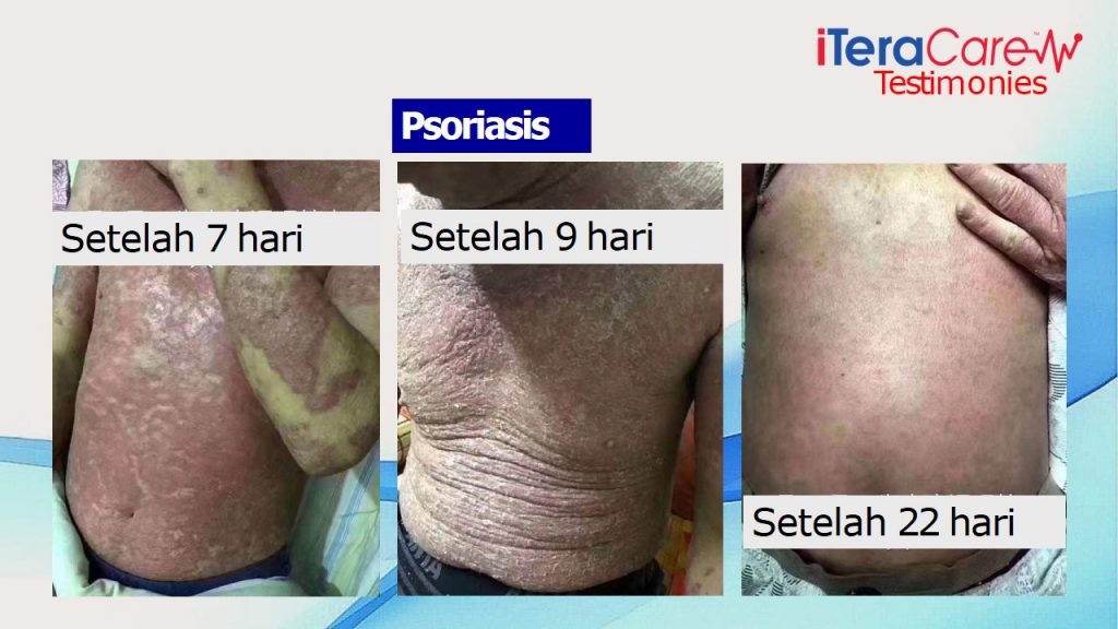 ITERA CARE